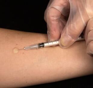 Subcutane testosteroninjectie